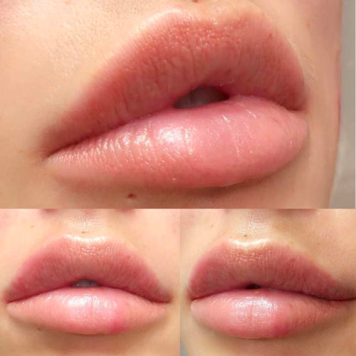 Keyhole lips - Mărire buze