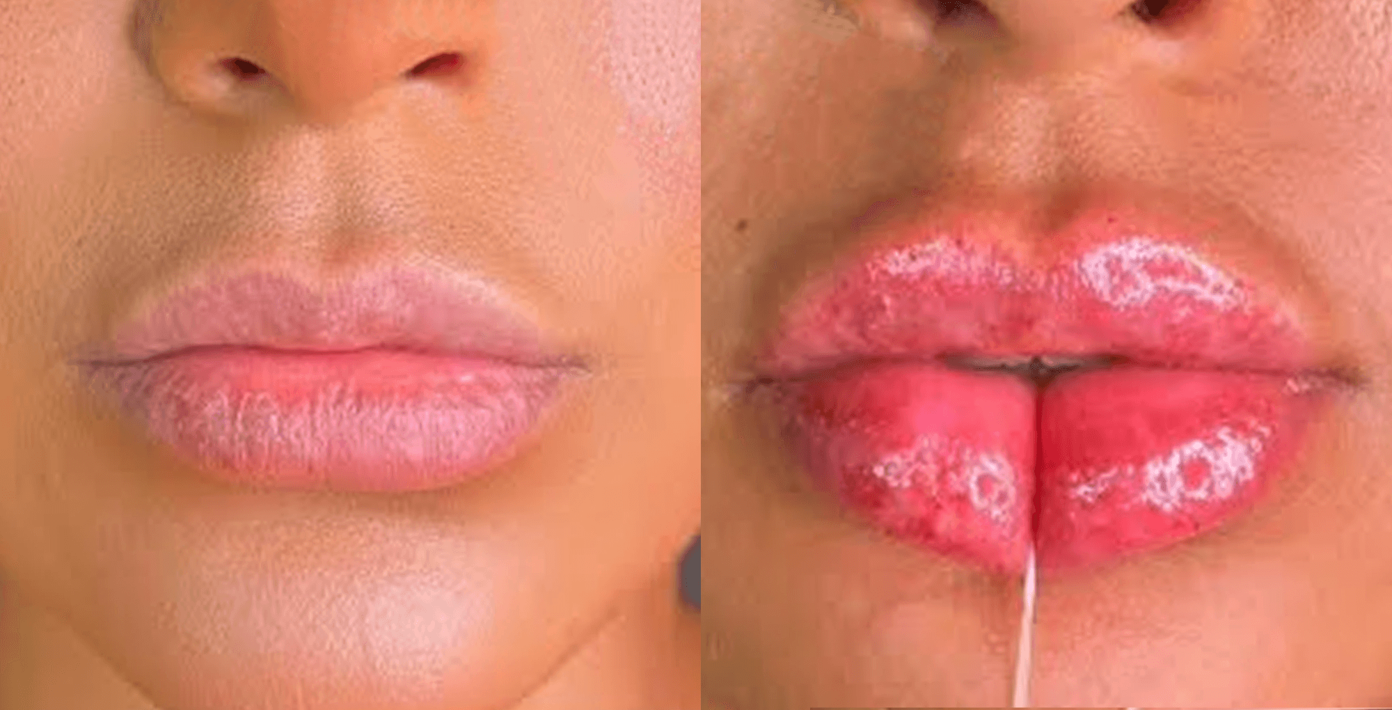 keyhole lips forma contur acid hialuronic dermatologie MedLink Craiova