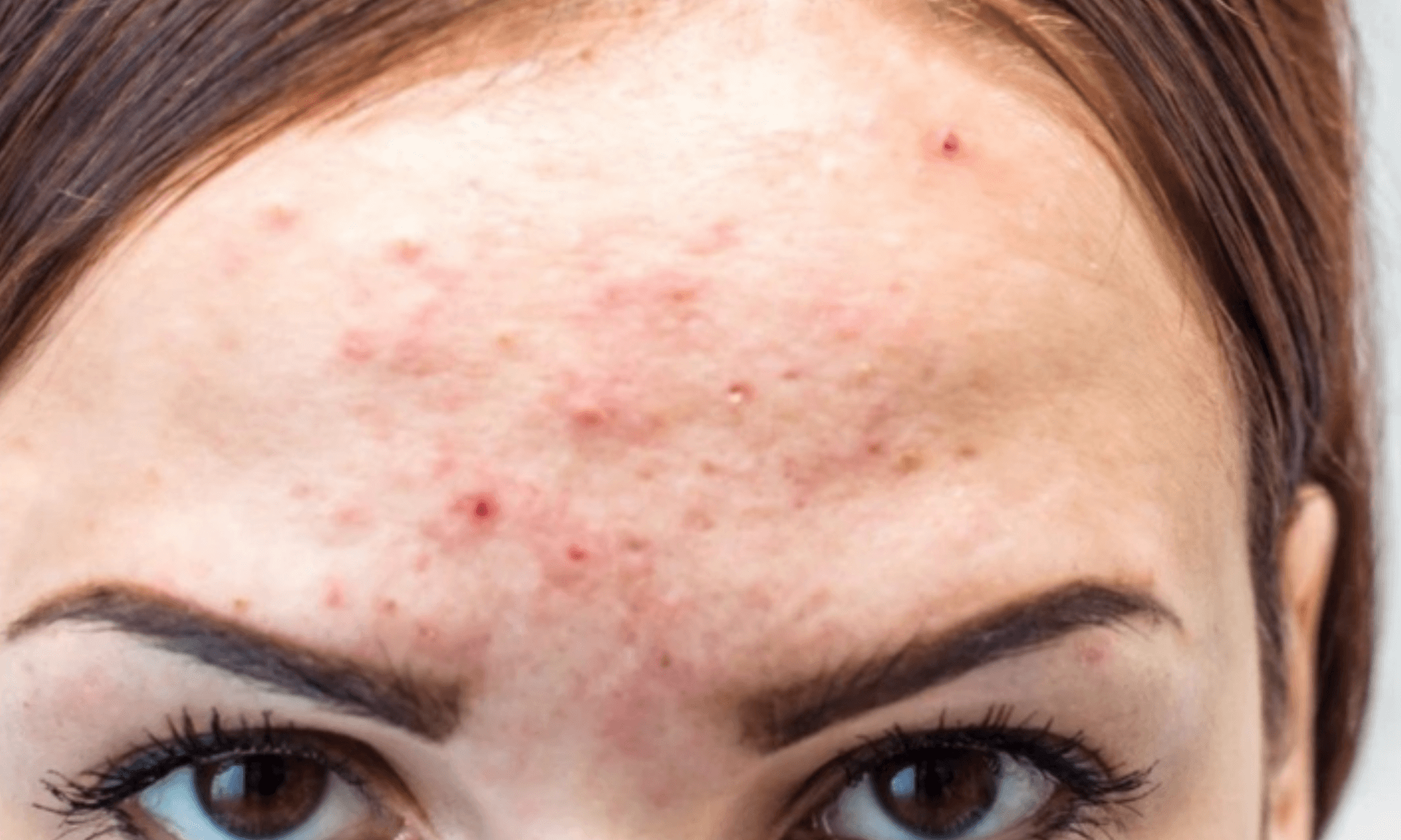 coșuri leziuni acnee semne postacneice dermatolog medlink center craiova
