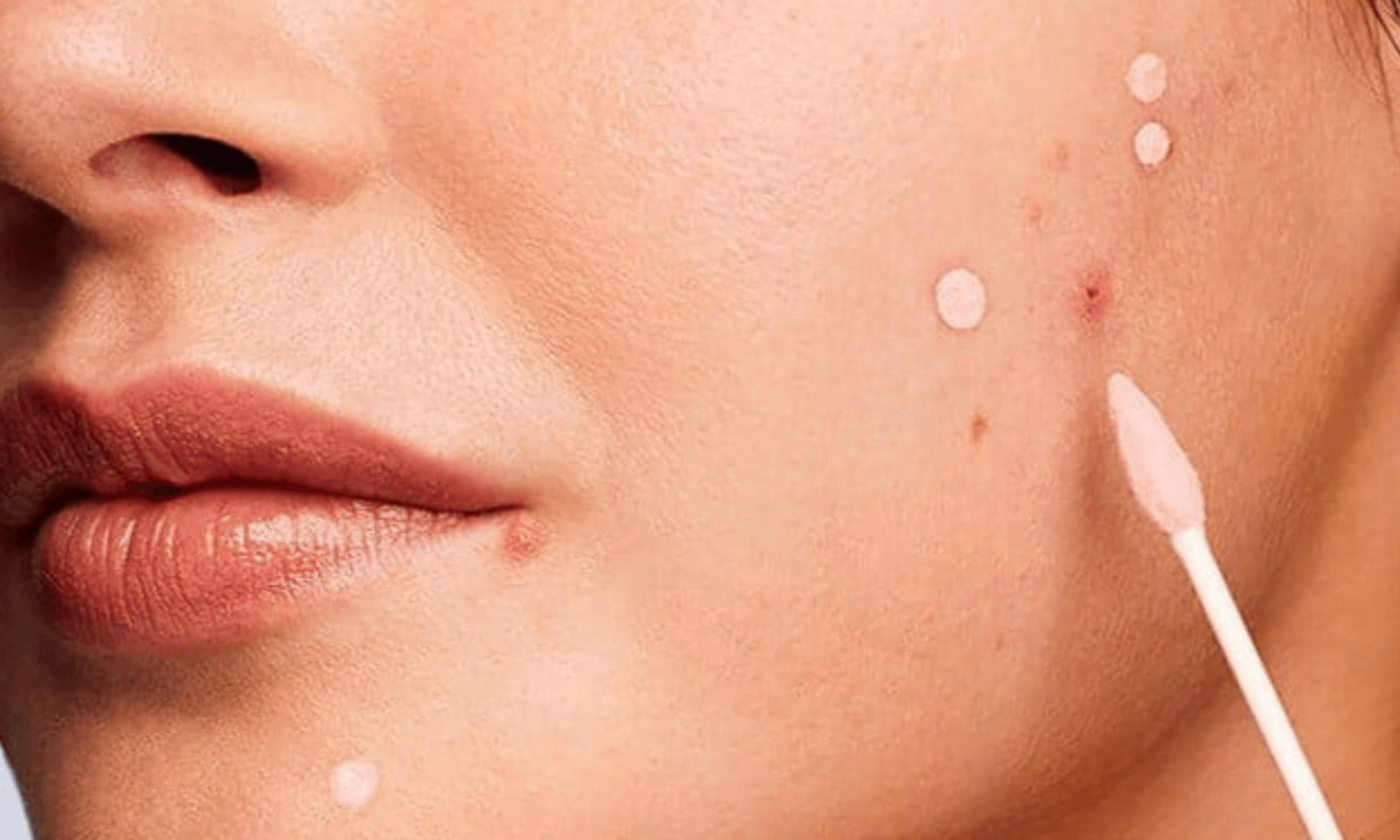 tratament coșuri acnee semne estetica dermatologie 