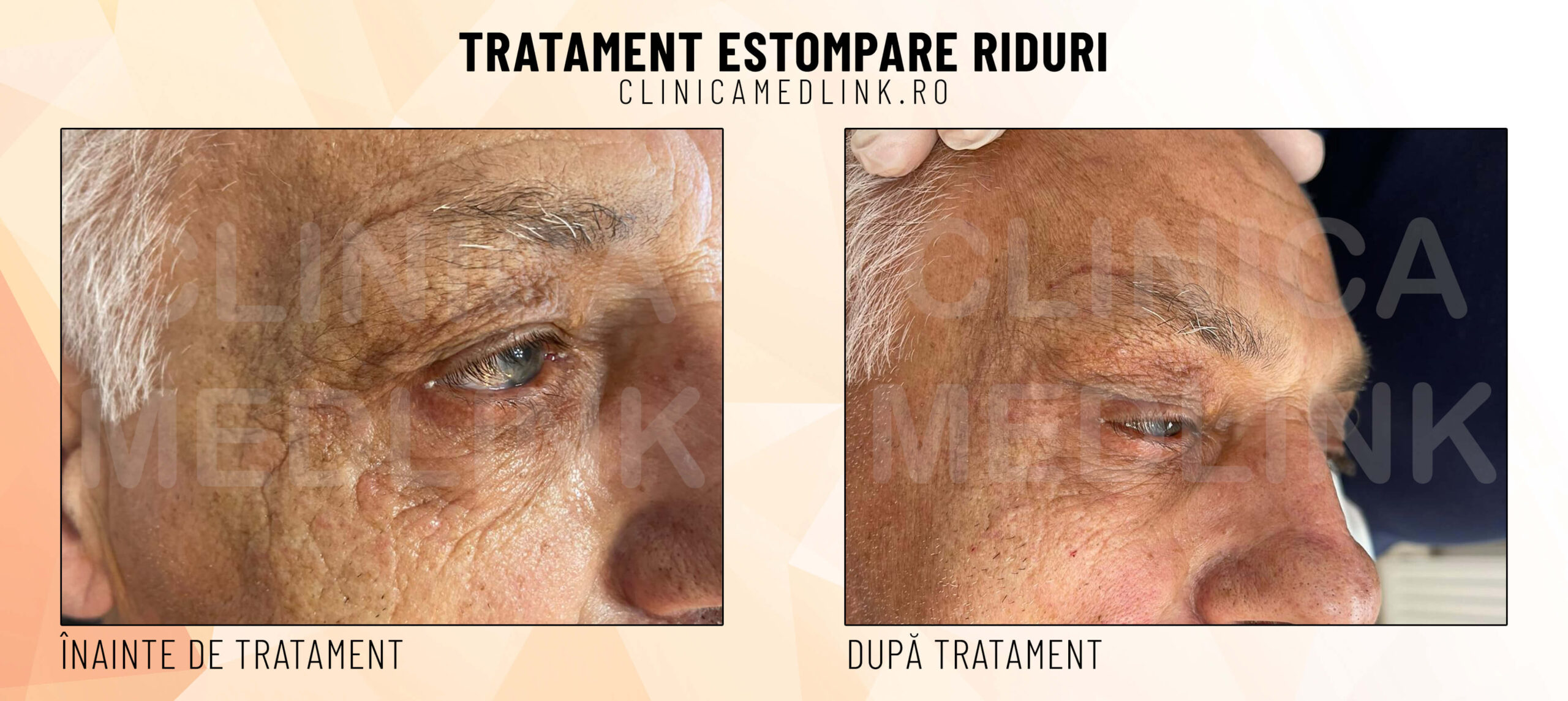 Before after riduri clinica medlink