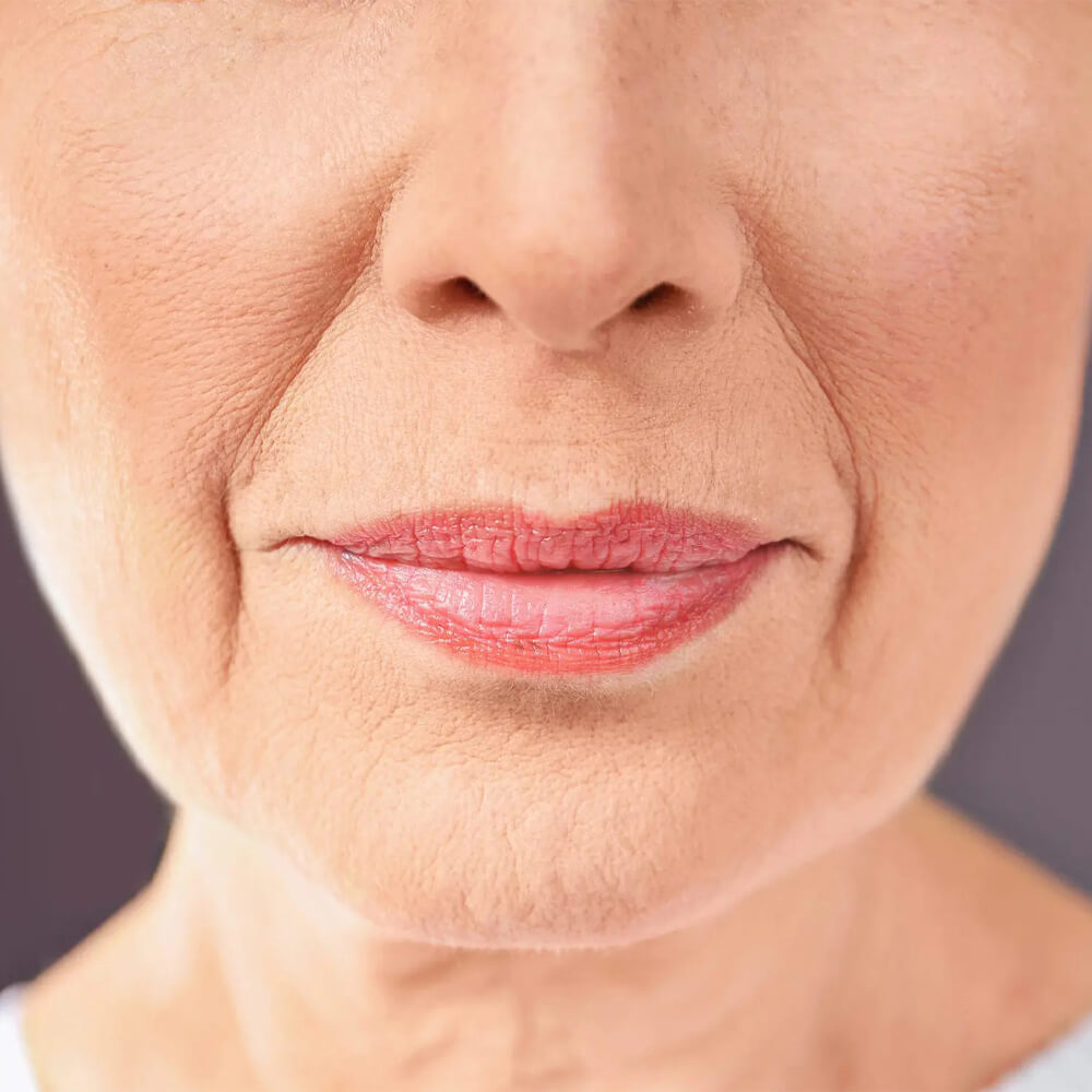 Tratament anti-îmbătrânire pentru ridurile dintre nas și gură