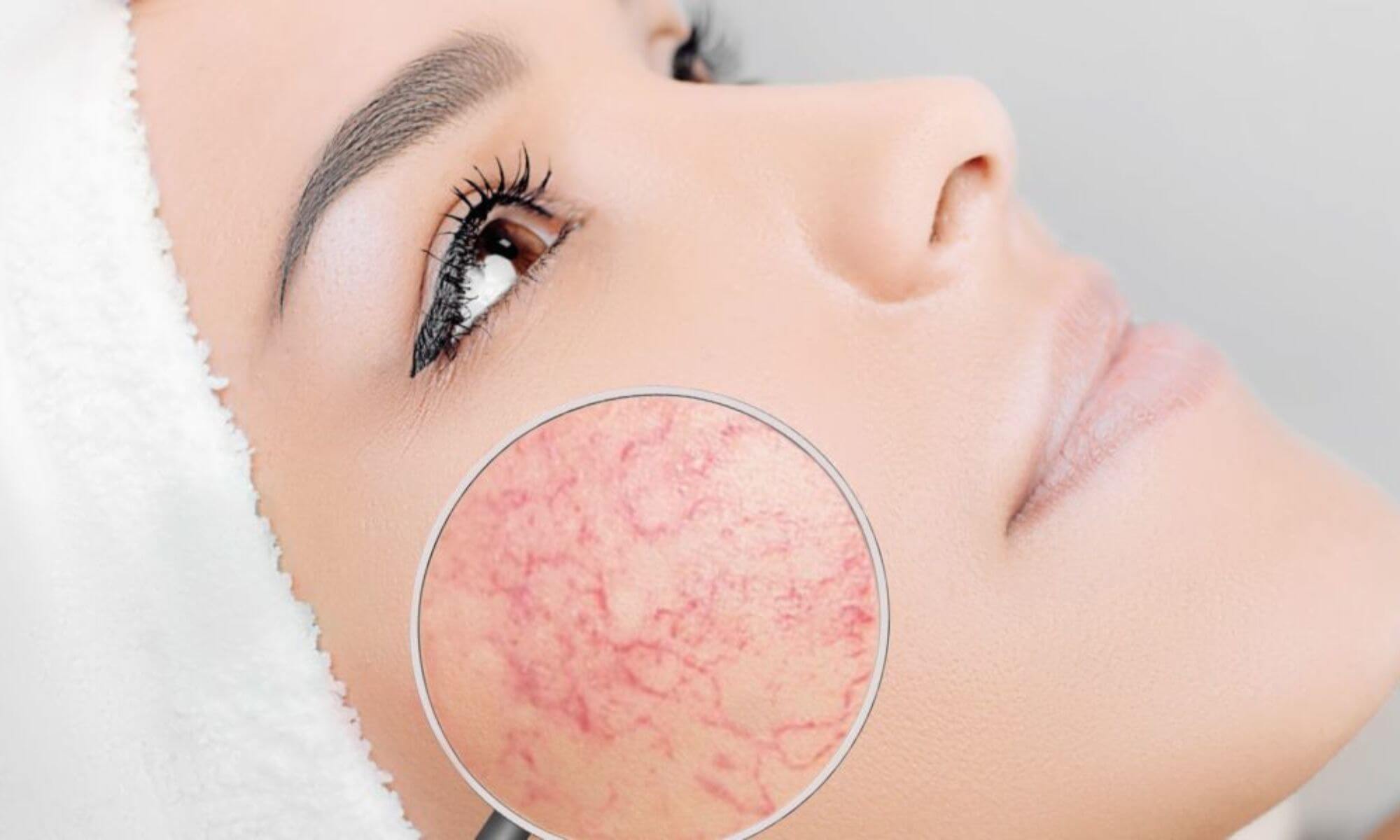 7 trucuri de îngrijirea tenului când ai acnee rozacee
