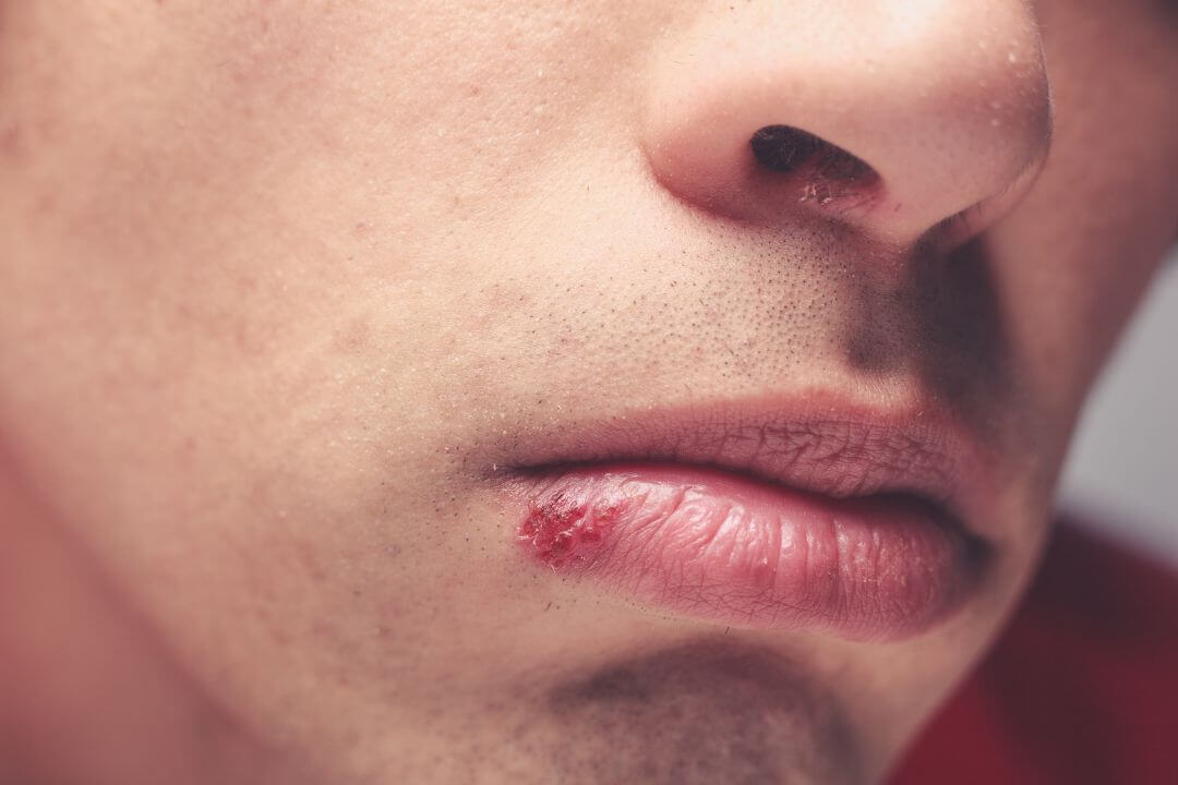 Boala 7 - Herpesul bucal