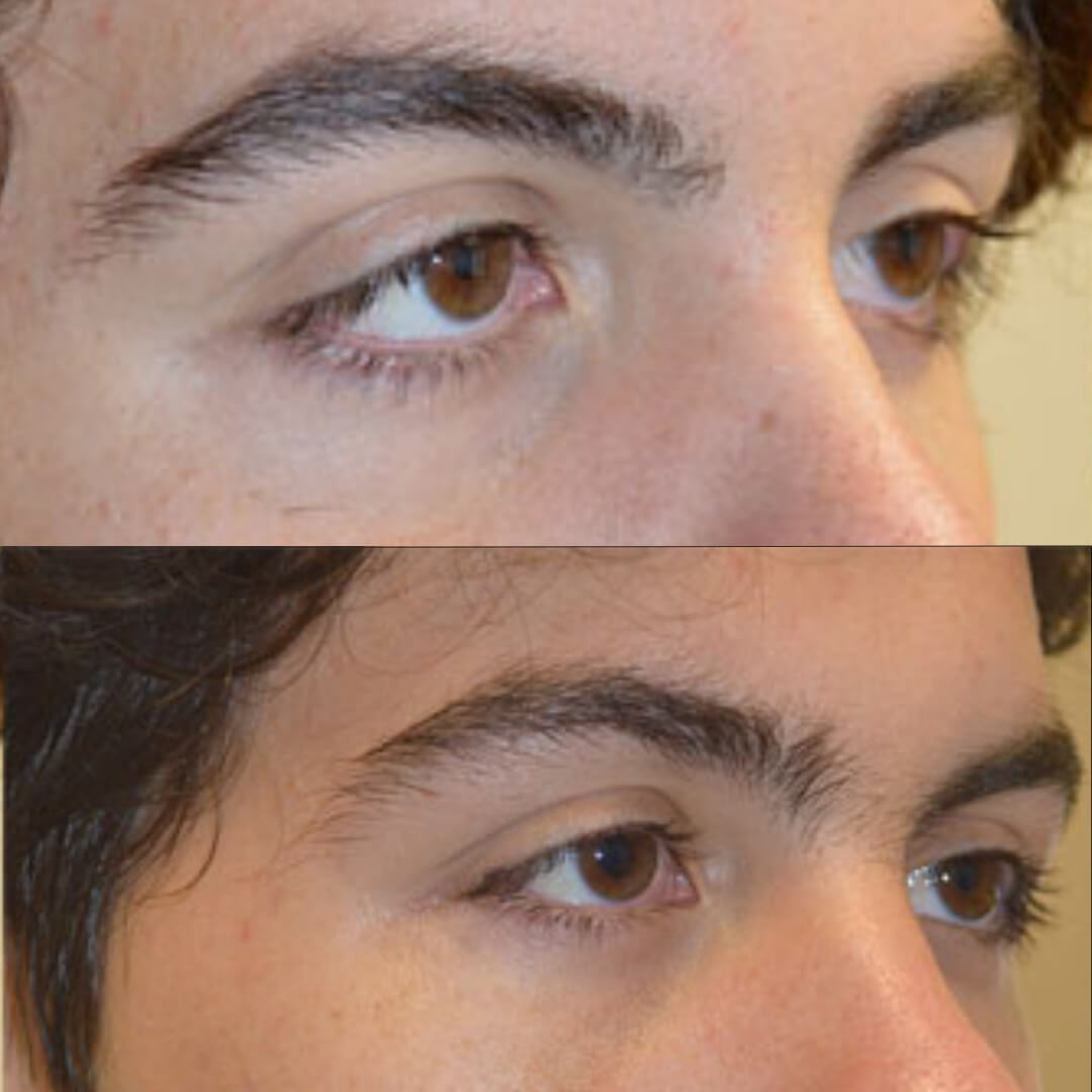 Pacient tânăr cu modificarea colțurilor ochilor