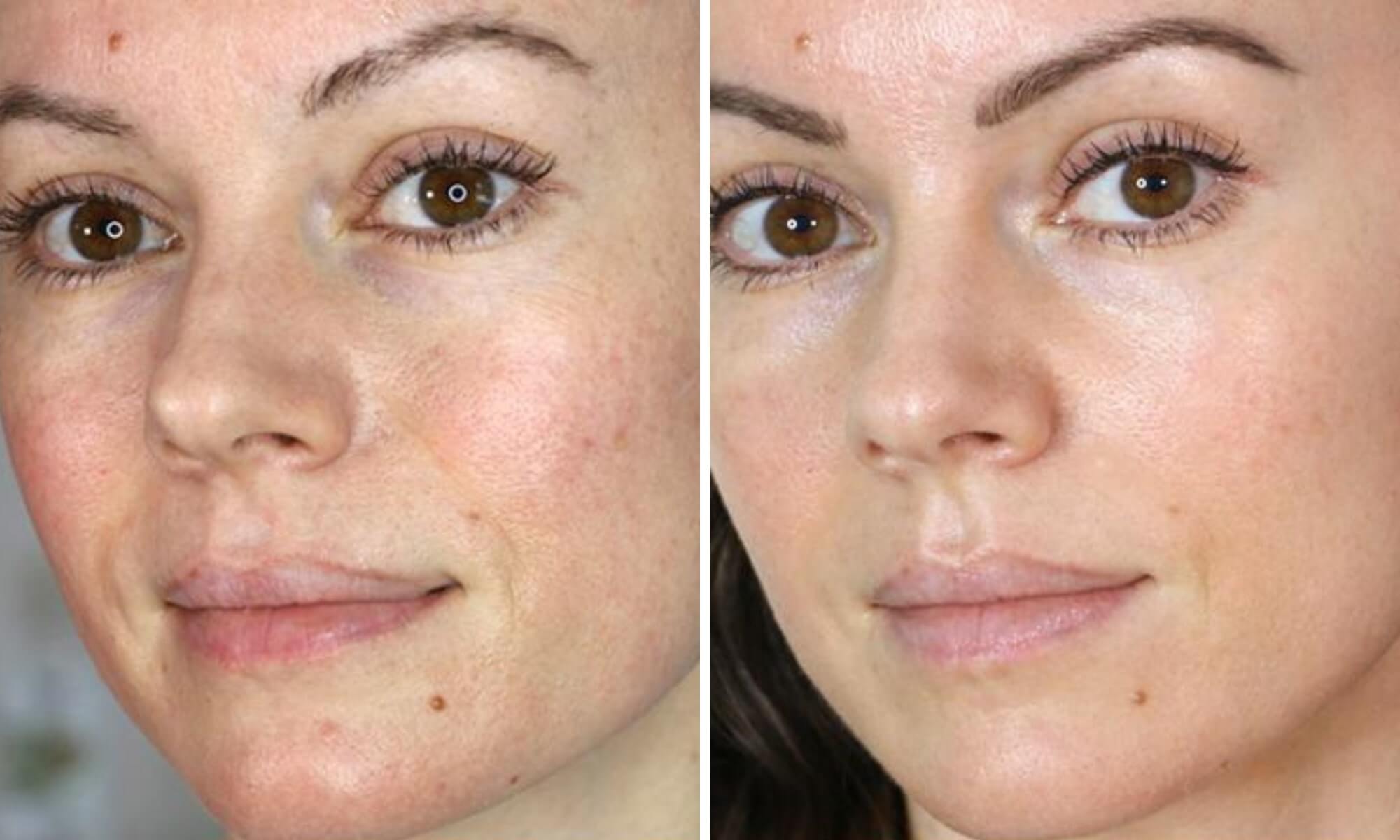 Paciente cu pete pigmentare - înainte și după