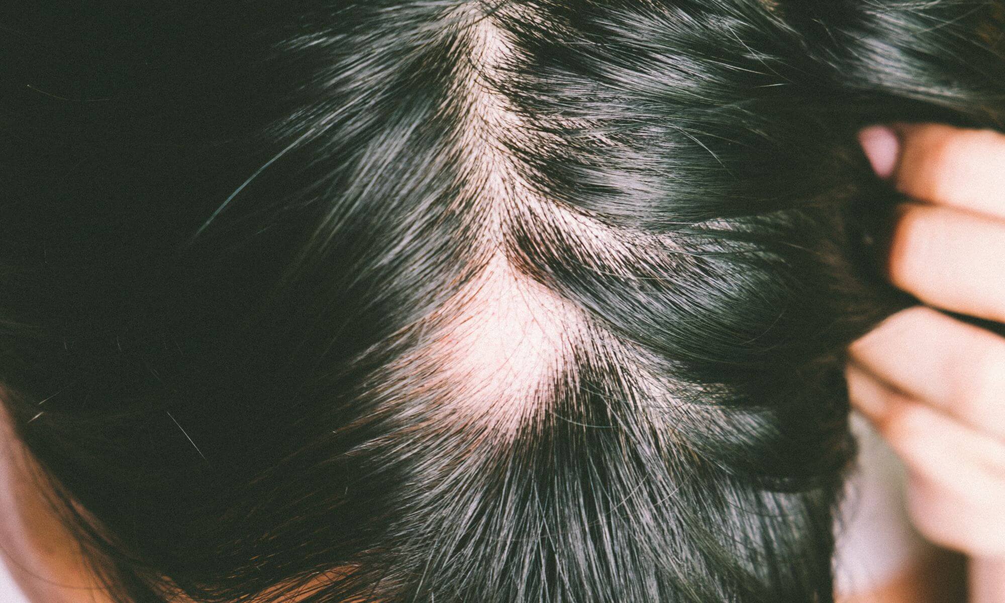 Alopecia Areata - boala imunitară de cădere a părului