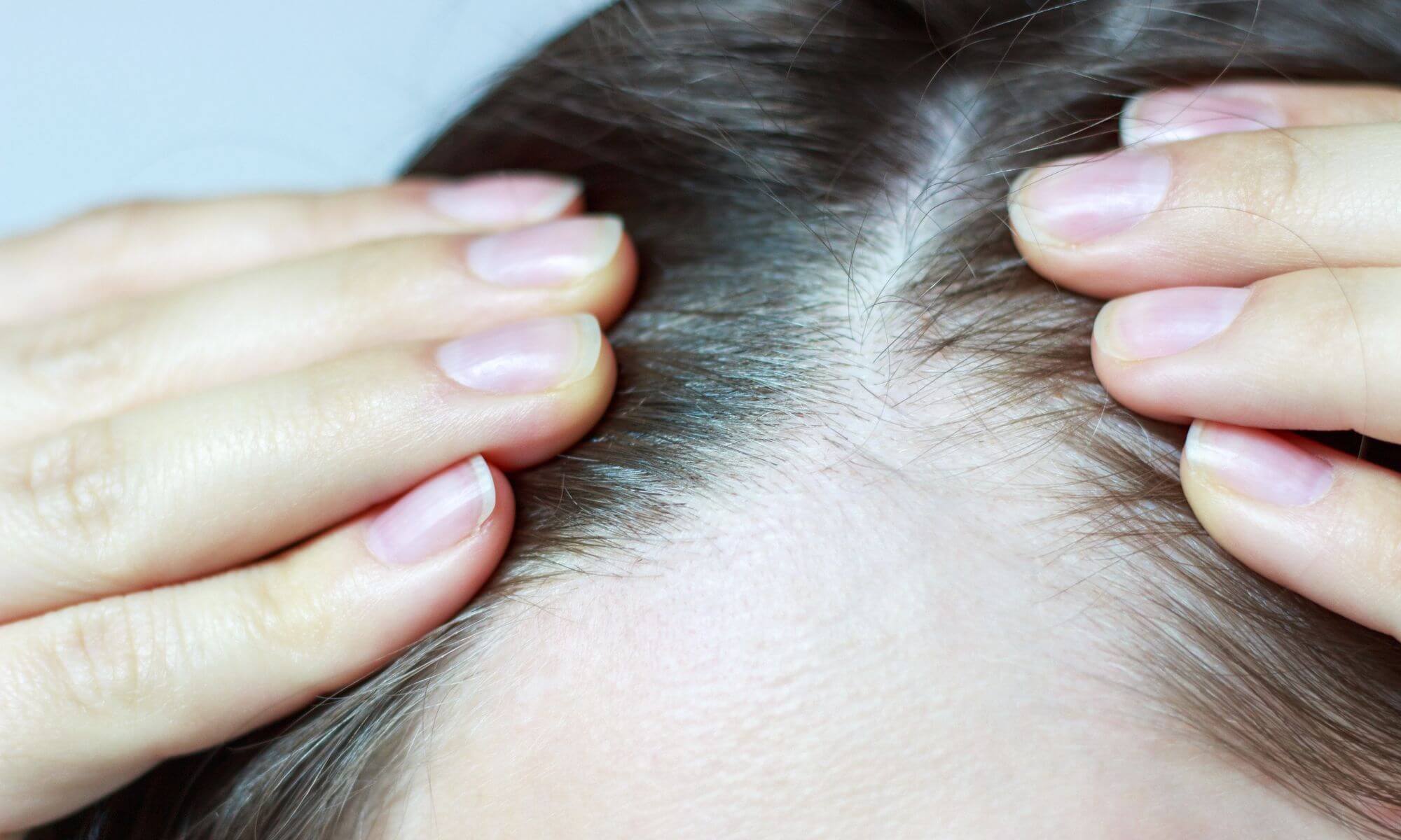 De ce cade părul la femei în cazul alopeciei androgenice