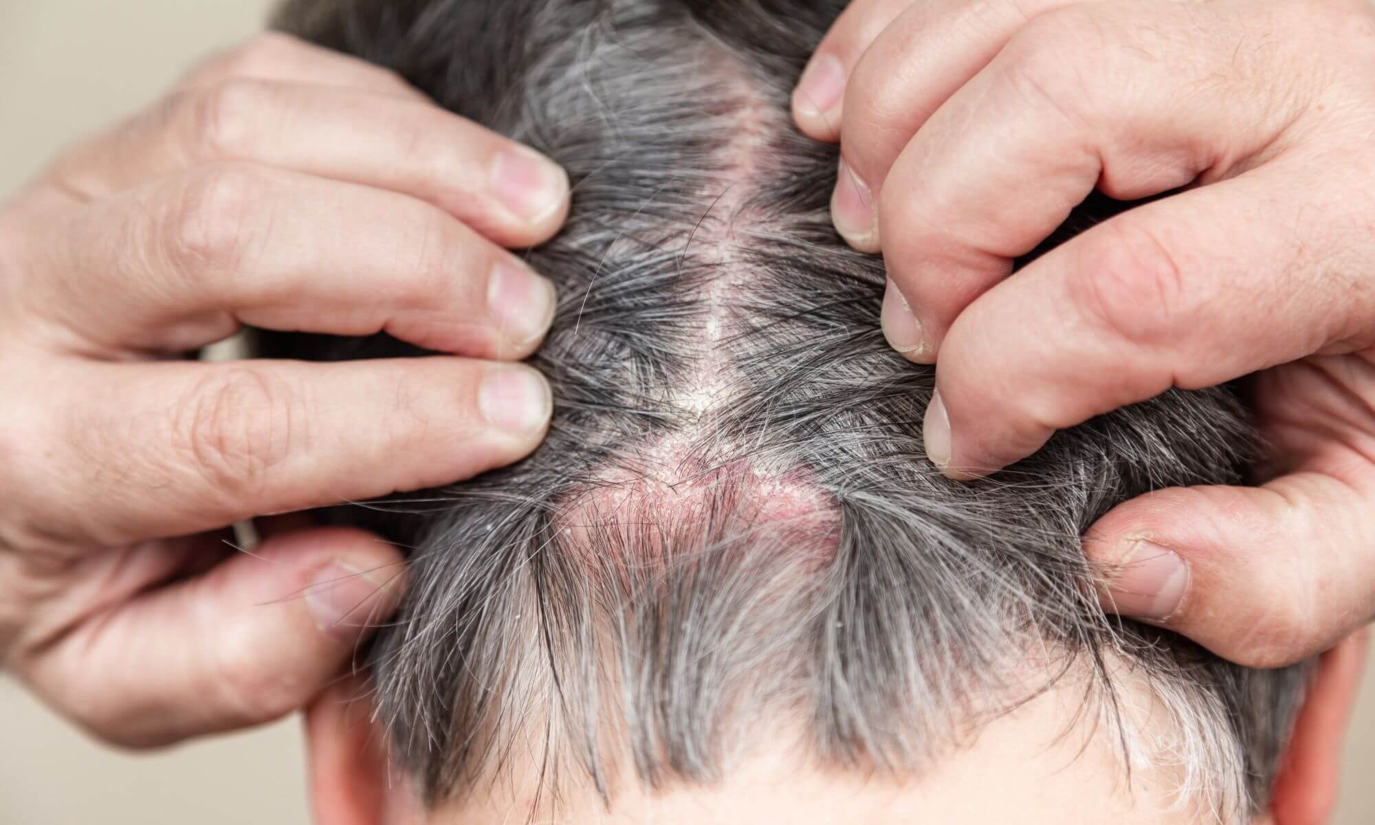 Iritație pe scalp la bărbați, de ce apare și cum pot scăpa de ea