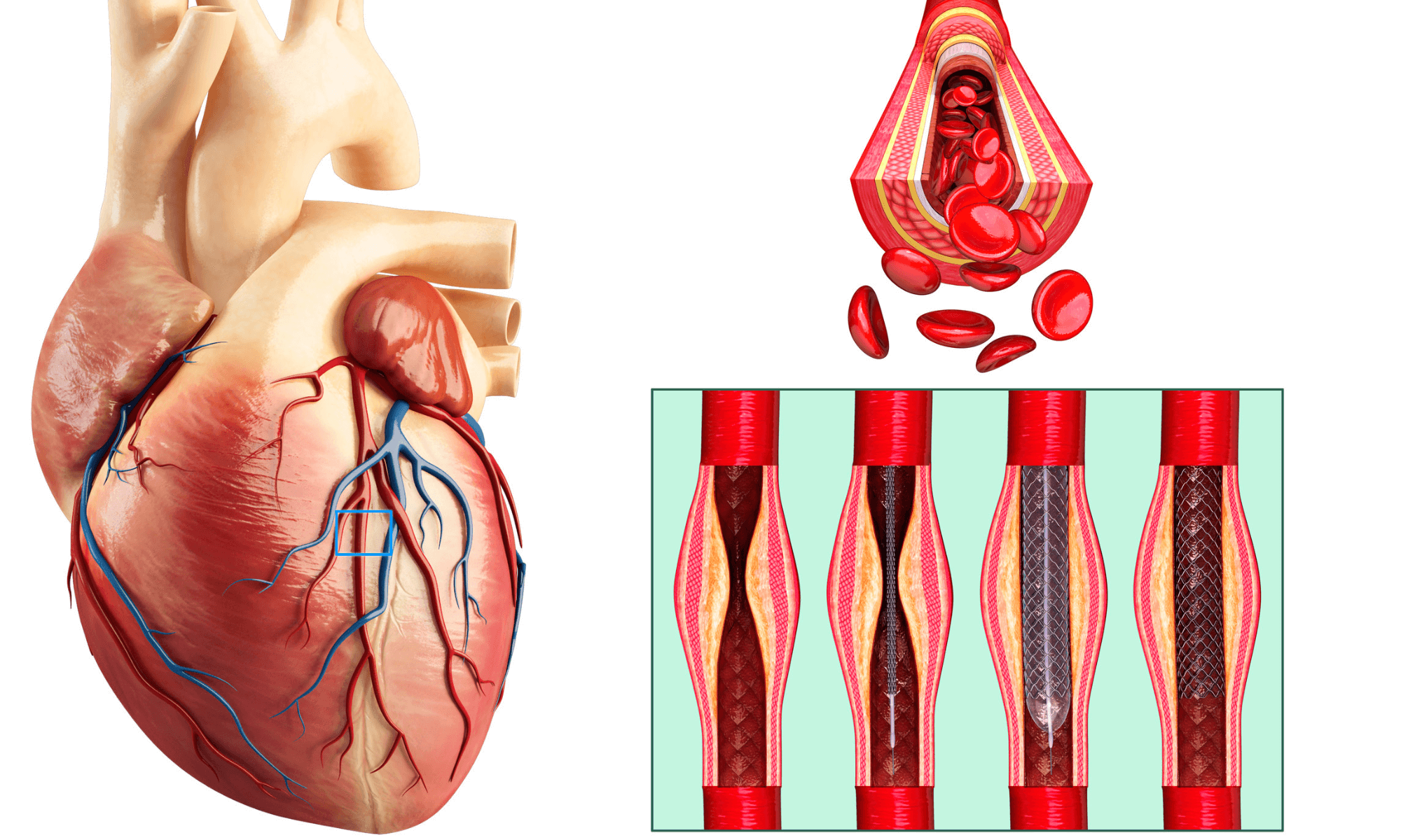 Ce se întâmplă dacă ignori simptomele unui infarct pe care îl duci pe picioare