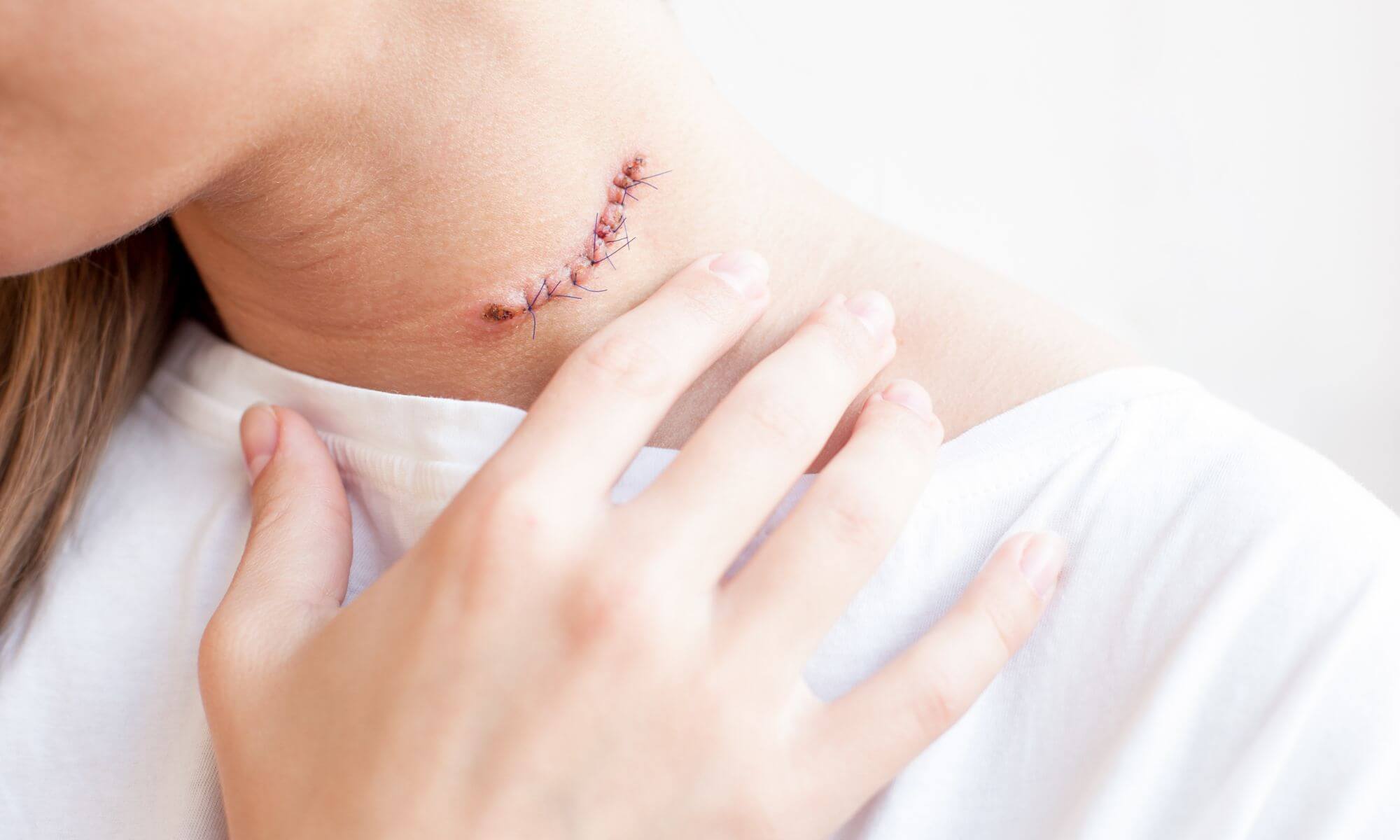 Cum să previi o cicatrizare inestetică după o operație de alunițe