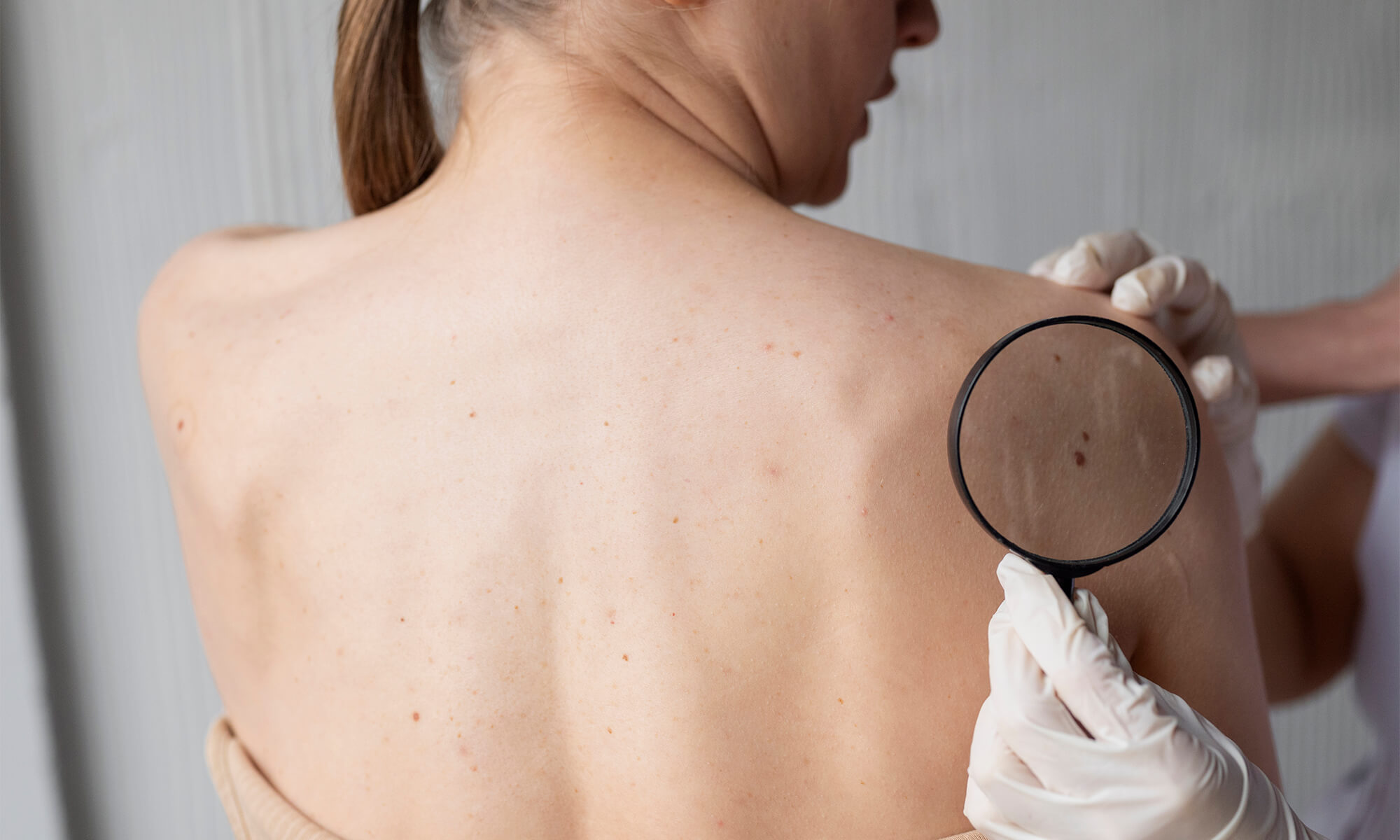 Cum faci prevenția pentru cancer de piele și care sunt riscurile